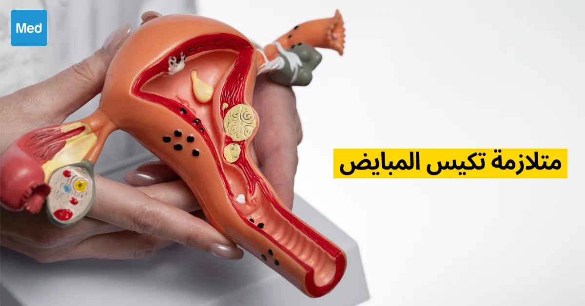 متلازمة المبيض المتعدد الكيسات